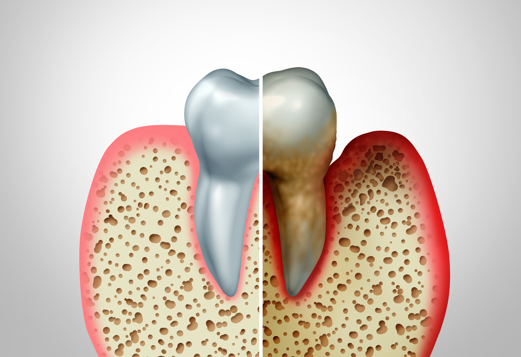 Qué es la periodontitis Institut Dental Barreras