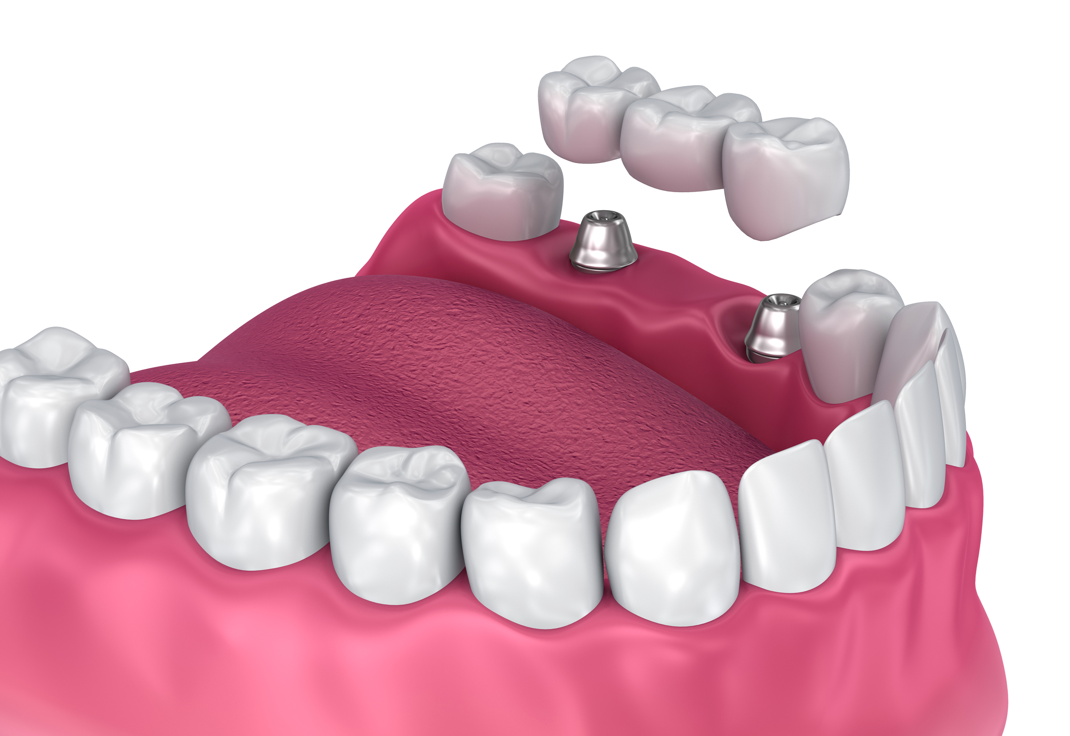 Implantes Dentales Todo Lo Que Necesitas Saber Barreras Clinica Dental Barcelona