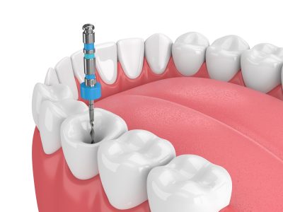 Endodoncia