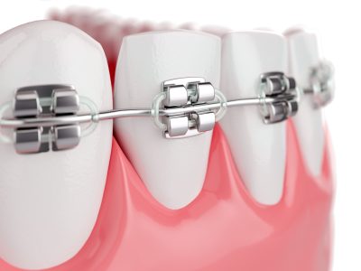 Limpieza dental SANT GERVASI