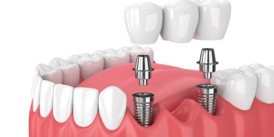 Puente sobre implantes