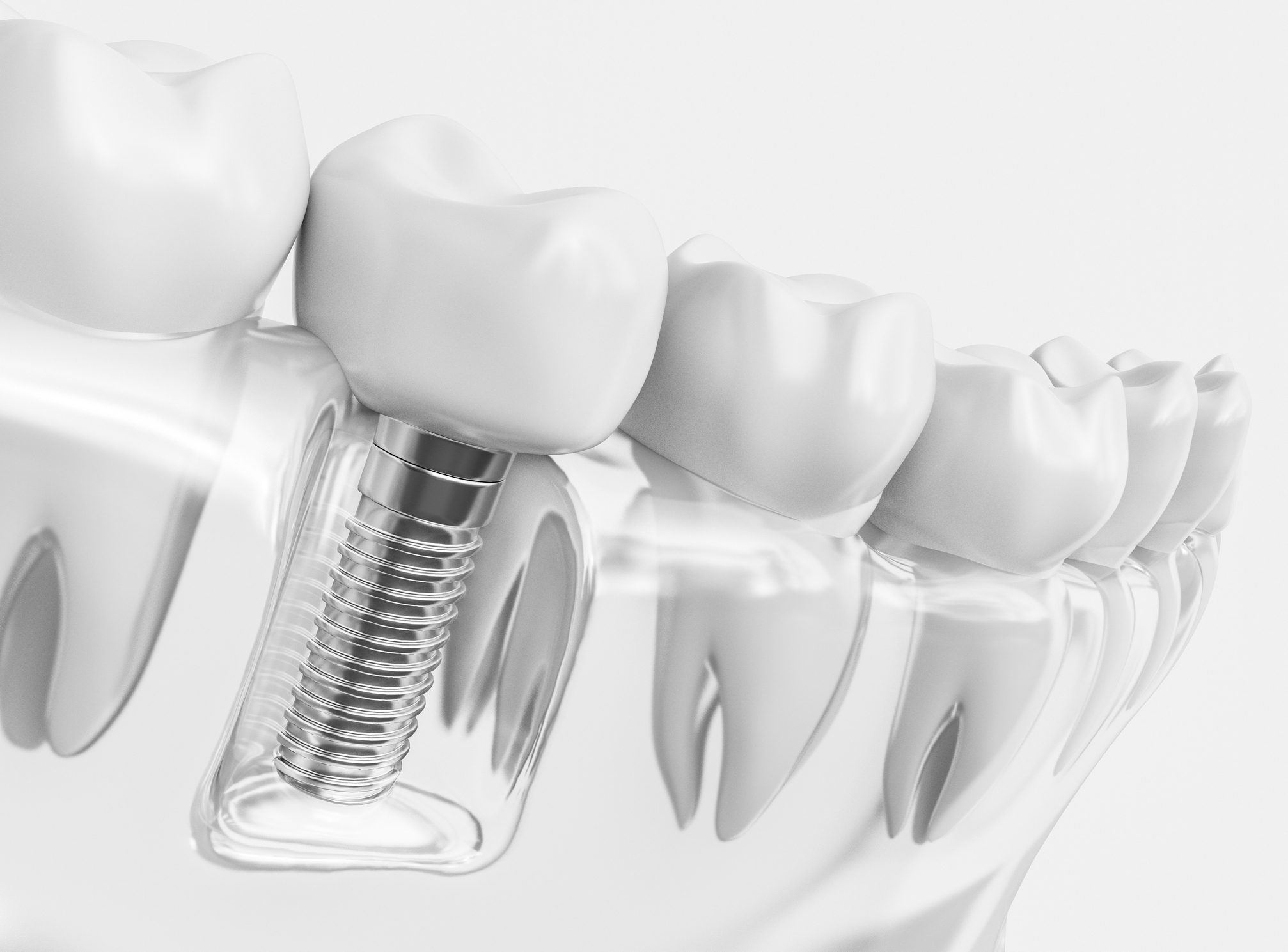 Dental Barreras implante straumann sant gervasi Dental Barreras implante straumann