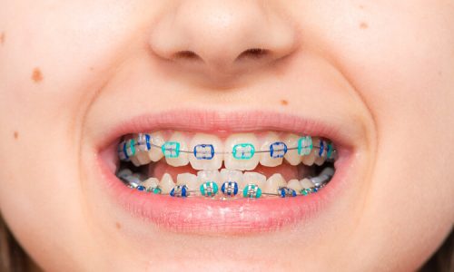 ortodoncia-infantil-martorell