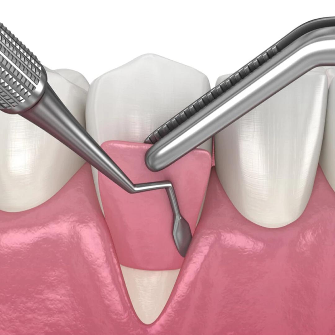 Cirugía periodontal Cirugía periodontal